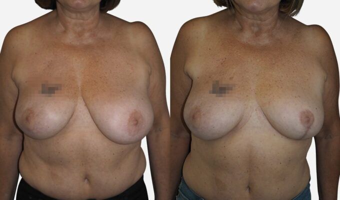 Correction d'une asymétrie mammaire à Paris par cure de ptôse mammaire (lifting du sein) avec Dr Sarfati