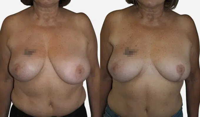 Chest before and after correction of left breast asymmetry by Dr. Benjamin Sarfati, Paris