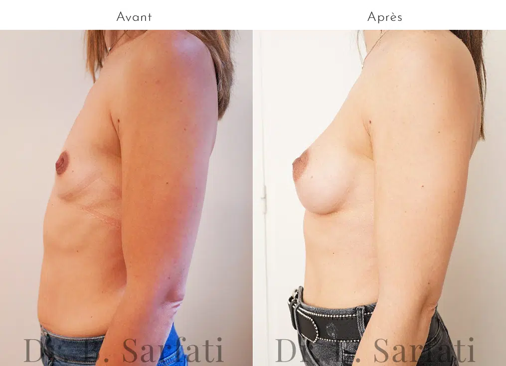 Female chest before and after breast augmentation with Urgotouch implants Dr. Benjamin Sarfati Paris