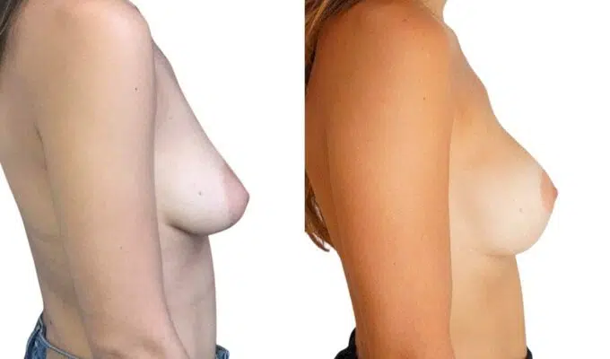 Breast before and after breast augmentation with implant Dr. Benjamin Sarfati Paris