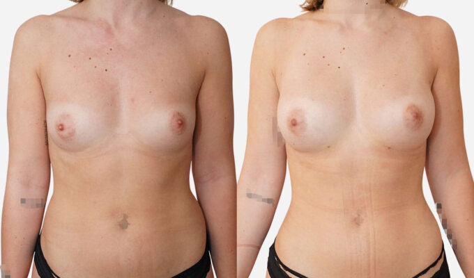 Avant après de l'augmentation des seins par lipofilling mammaire à Paris | Dr Benjamin Sarfati | Paris