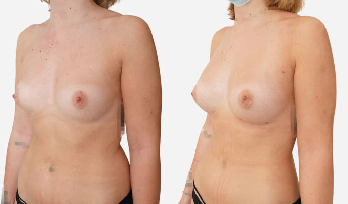 injection de graisse pour augmenter les seins ( lipofilling) | Dr Benjamin Sarfati | Paris