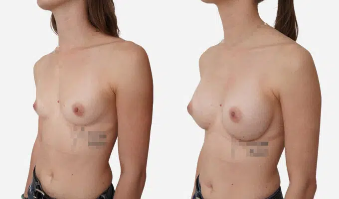 Breast before and after breast augmentation with implant Dr. Benjamin Sarfati Paris
