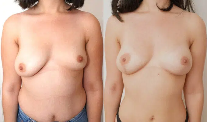 Correction of breast asymmetry in Paris by Dr. Benjamin Sarfati