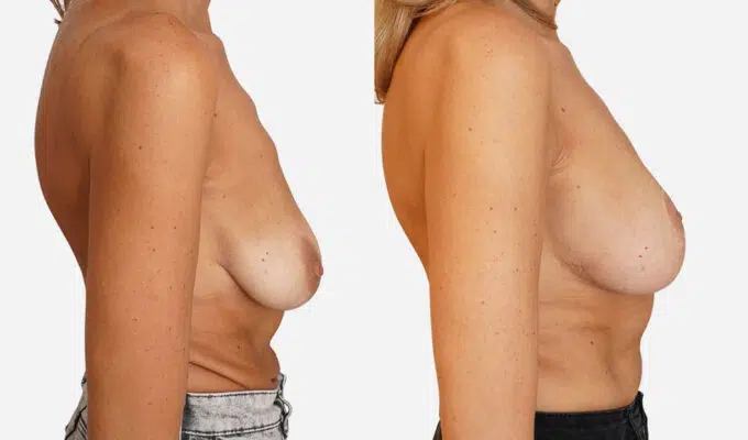 Left profile chest before and after breast augmentation and ptosis correction Dr. Benjamin Sarfati Paris