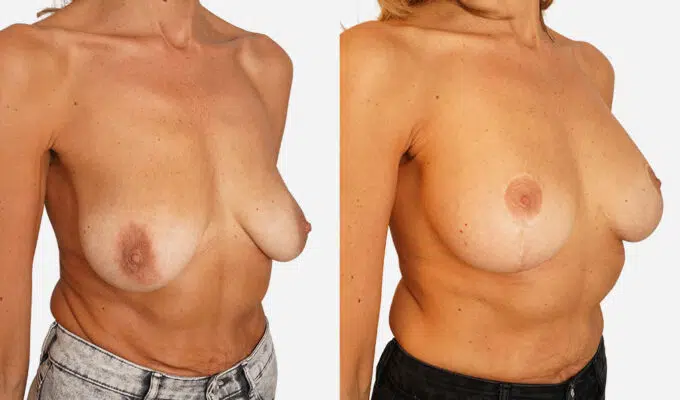Female chest front view before and after breast augmentation and ptosis correction Dr. Benjamin Sarfati Paris