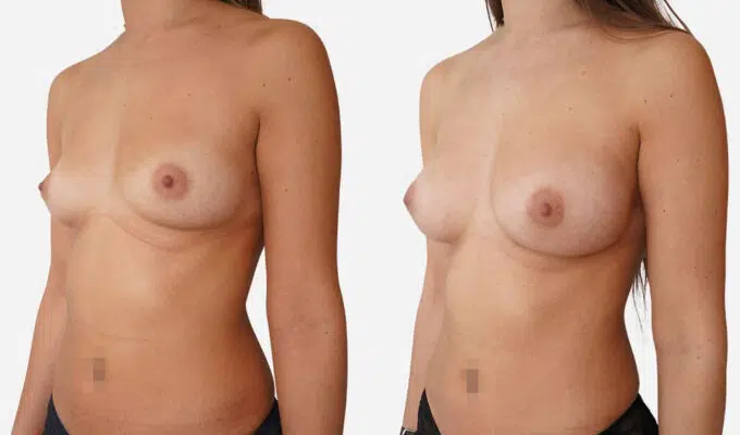 Poitrine de profile avant et apres augmentation mammaire et cure de ptose Dr benjmain Sarfati paris