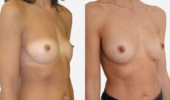 Female chest before and after breast augmentation with implants Dr. Benjamin Sarfati Paris