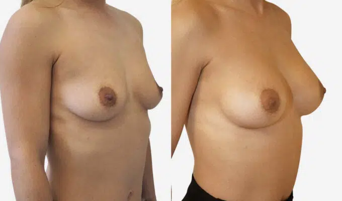 Breast before and after breast augmentation with implant Dr. Benjamin Sarfati Paris