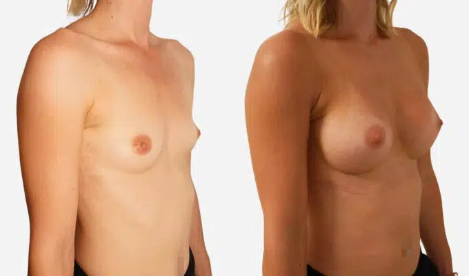 Female chest before and after 285cc breast augmentation Dr. Benjamin Sarfati Paris