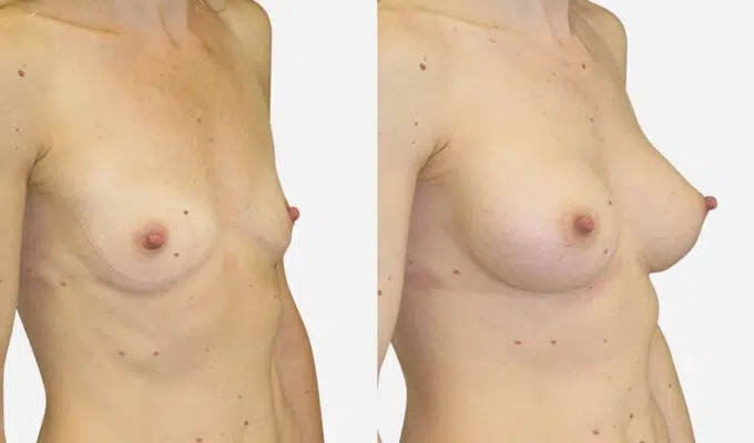 Breast before and after breast augmentation with implant Dr. Benjamin Sarfati Paris