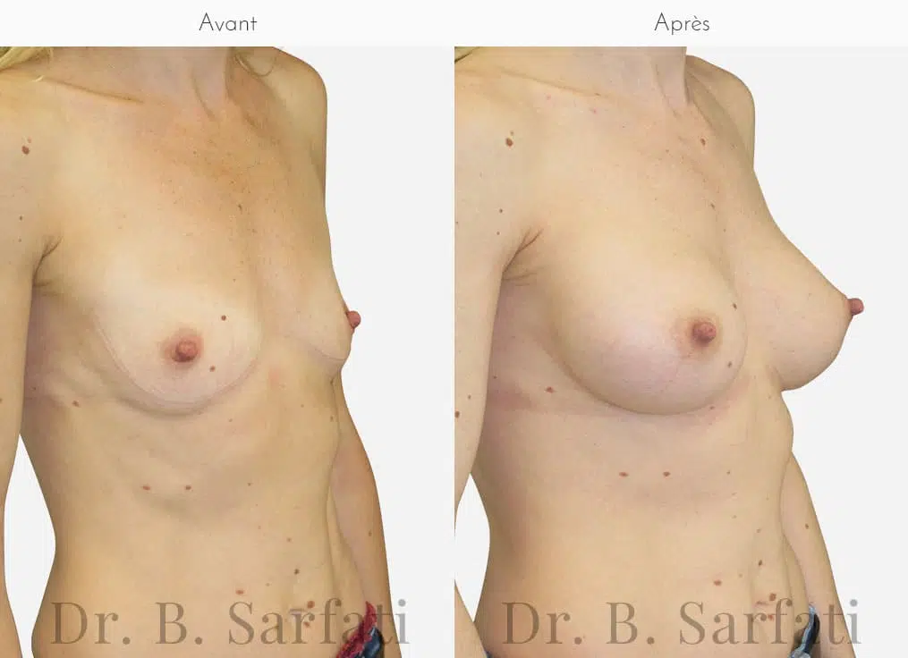 Poitrine avant et apres augmentation mammaire par prothese Dr Benjamin Sarfati Paris