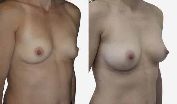 Female chest before and after breast augmentation with implants Dr. Benjamin Sarfati Paris