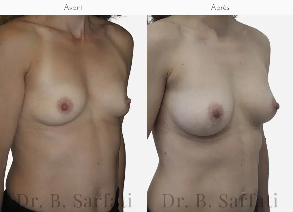 Poitrine de femme avant et apres operation d augmentation mammaire par prothese Dr Benjamin Sarfati paris