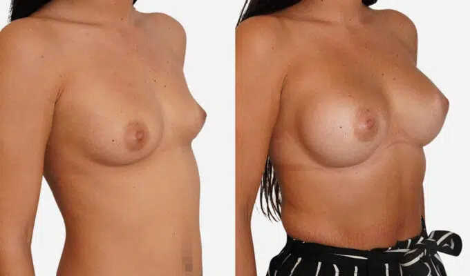 Breast before and after breast augmentation with implant Dr. Benjamin Sarfati Paris