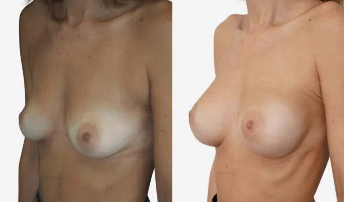 Female chest before and after breast augmentation with implants Dr. Benjamin Sarfati Paris