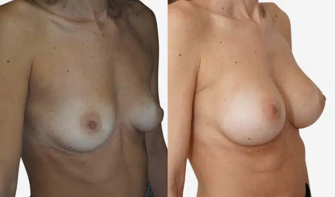 Breast before and after breast augmentation with implant Dr. Benjamin Sarfati Paris