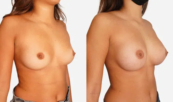 Breast before and after breast augmentation with inframammary scars Dr. Benjamin Sarfati Paris