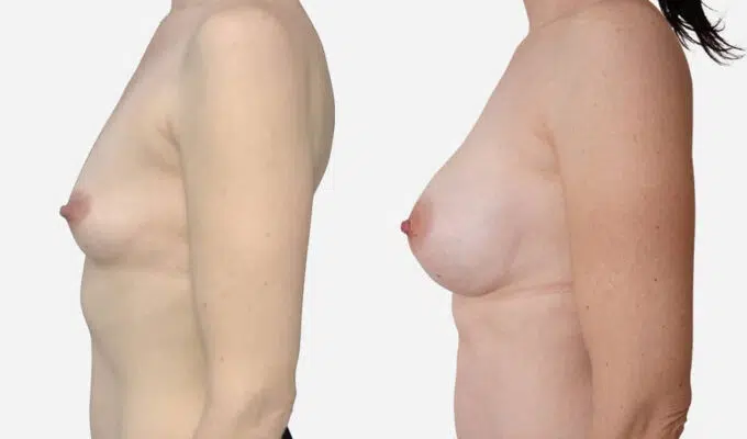Female chest before and after breast augmentation with inframammary scars Dr. Benjamin Sarfati Paris