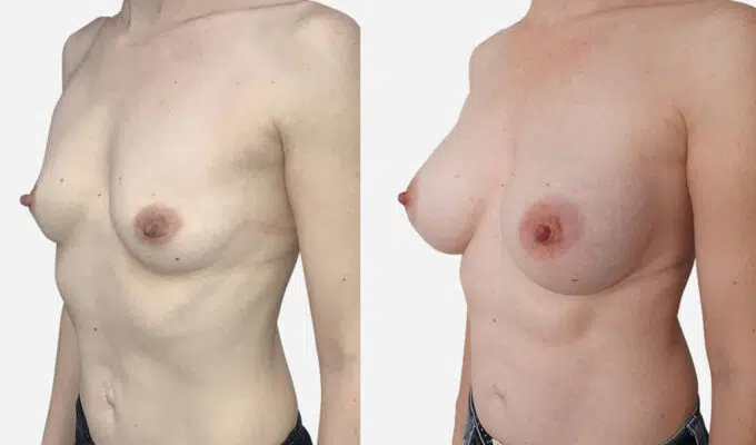 Breast before and after breast augmentation with inframammary scars Dr. Benjamin Sarfati Paris