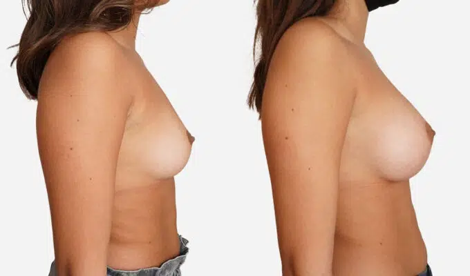 Female chest before and after breast augmentation surgery with implants and inframammary scars Dr. Benjamin Sarfati Paris