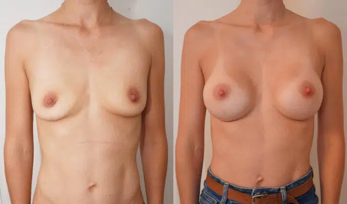 Breast before and after augmentation with Urgotouch implants Dr. Benjamin Sarfati Paris
