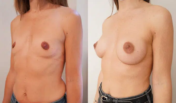 Female chest before and after breast augmentation with Urgotouch implants Dr. Benjamin Sarfati Paris