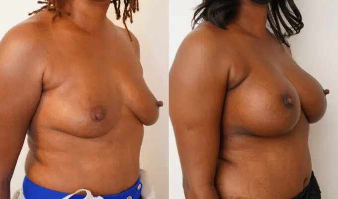 Breast before and after augmentation with Urgotouch implants Dr. Benjamin Sarfati Paris