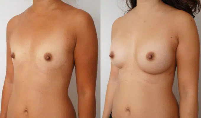 Female chest before and after breast augmentation with Urgotouch implants Dr. Benjamin Sarfati Paris