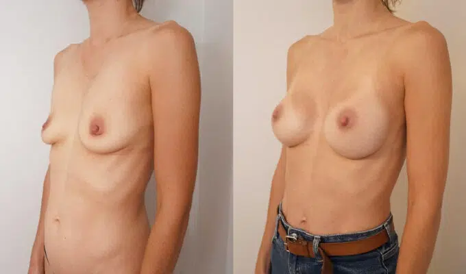 Breast before and after augmentation with Urgotouch implants Dr. Benjamin Sarfati Paris