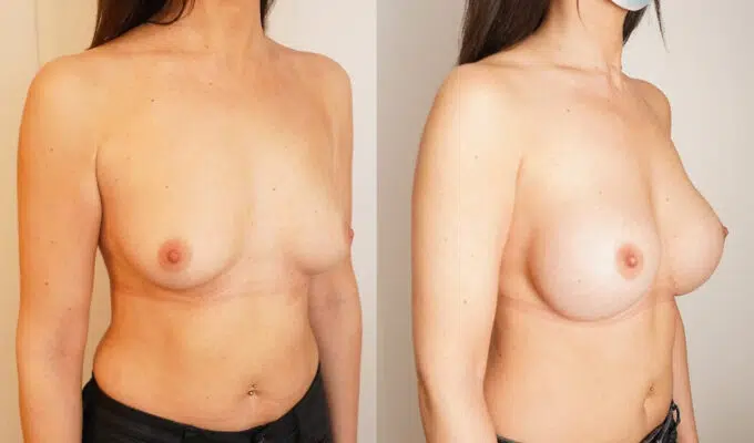 Female chest before and after breast augmentation with Urgotouch implants Dr. Benjamin Sarfati Paris