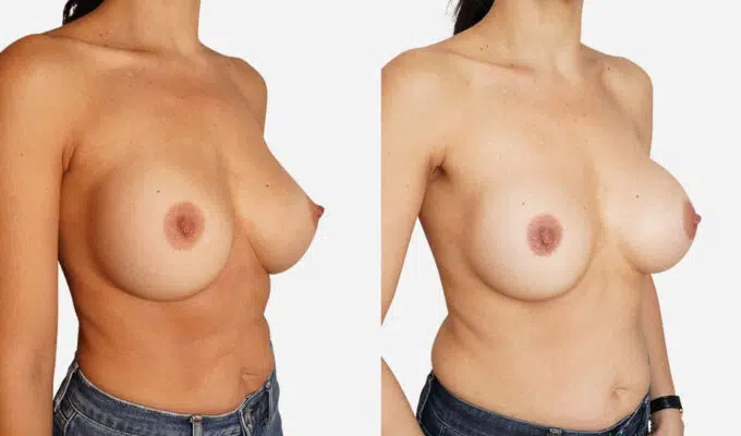 Breast before and after breast implant replacement Dr. Benjamin Sarfati Paris