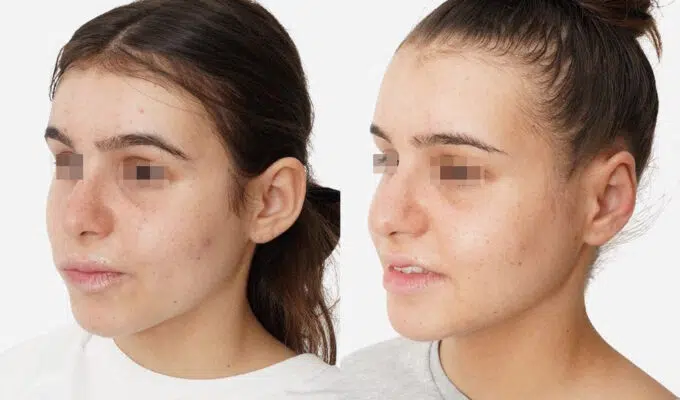 Visage de femme montrant les oreilles avant et apres otoplastie chirurgie des oreilles decollees Dr Benjamin Sarfati paris