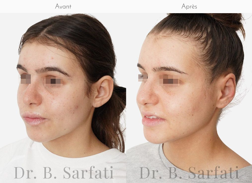Visage de femme de profil montrant les oreilles avant et apres otoplastie chirurgie des oreilles decollees Dr Benjamin Sarfati paris