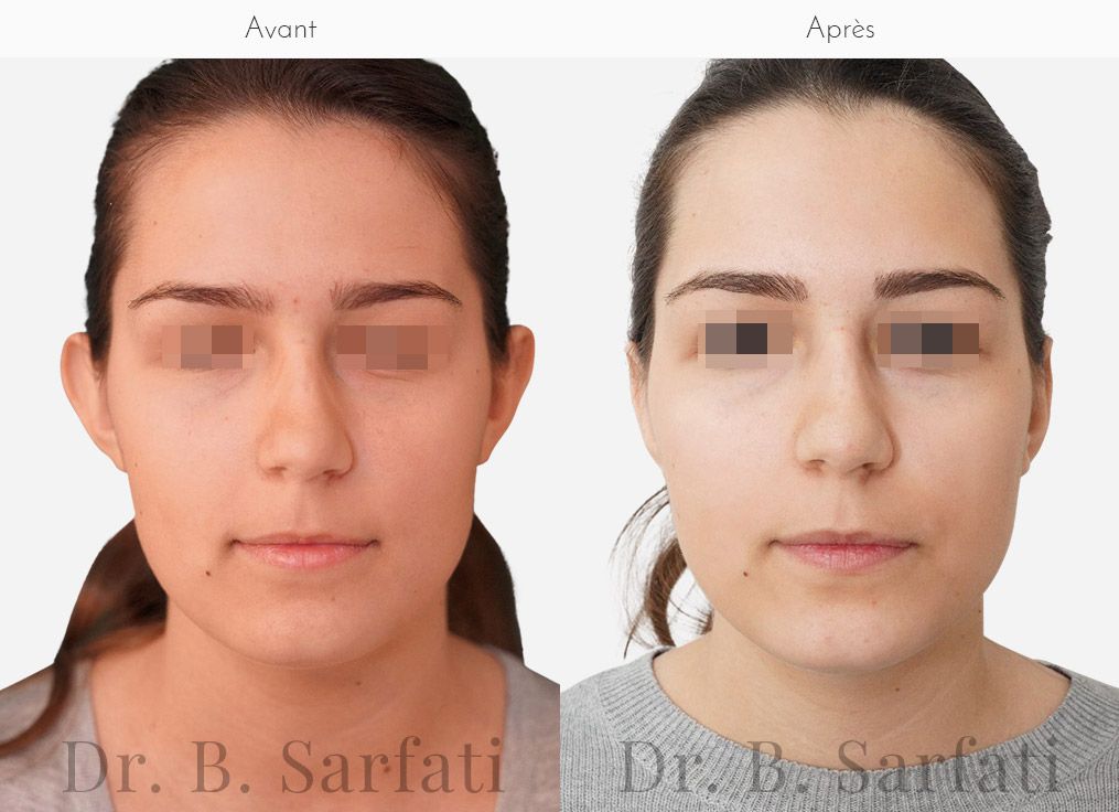 Visage de femme montrant les oreilles avant et apres otoplastie chirurgie des oreilles decollees Dr Benjamin Sarfati paris