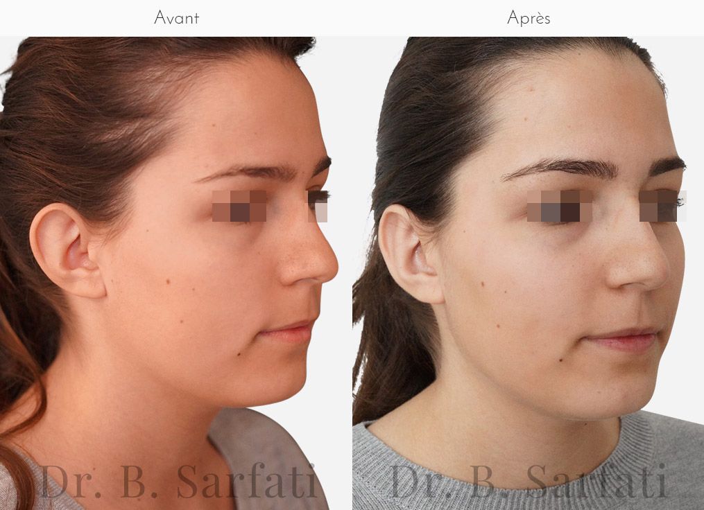 Visage de femme montrant les oreilles avant et apres otoplastie chirurgie des oreilles decollees Dr Benjamin Sarfati paris