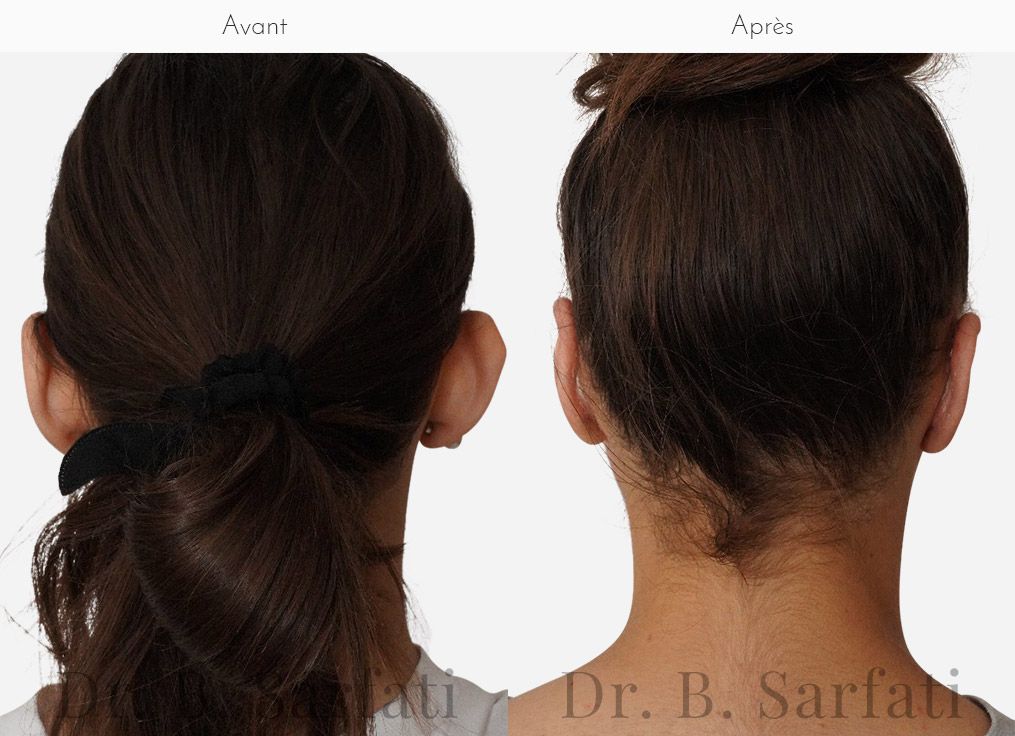 Tete de femme vu par deriere montrant les oreilles avant et apres ortoplastie chirurgie des oreilles decollees Dr Benjamin Sarfati paris