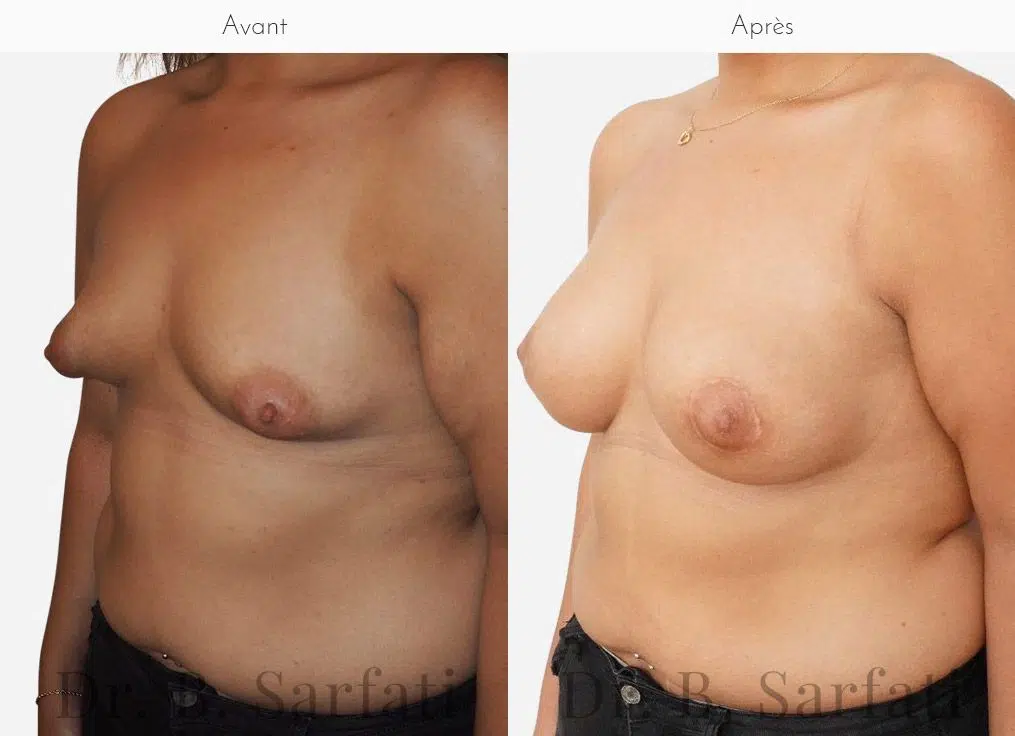 Breasts before and after correction of tuberous breasts Dr. Benjamin Sarfati Paris