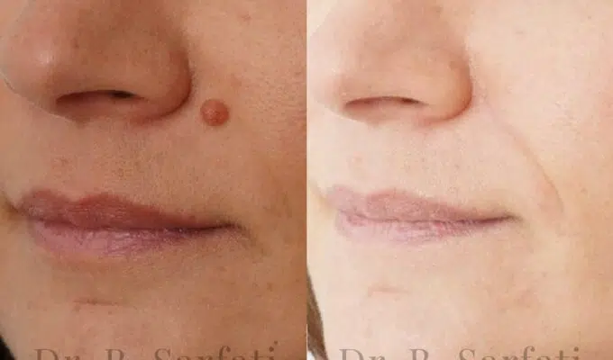 Grain de beaute sur le visage avant et apres ablation avec une cicatrice cache au niveaue du plis du visage Dr Benjamin Sarfati paris