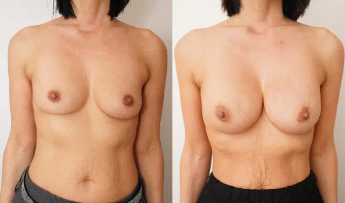 Poitrine de femme avant et apres Lipofilling mammaire bilateral Dr benjmin Sarfati Paris
