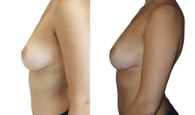 Poitrine de femme avant et apres mastectomie bilaterale avec conservation de l areole Dr Benjamin Sarfati paris