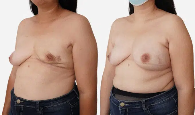 Poitrine  avant et apres mastectomie du sein gauche Dr Benjamin Sarfati paris