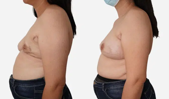 Poitrine de femme avant et apres mastectomie du sein gauche Dr Benjamin Sarfati paris