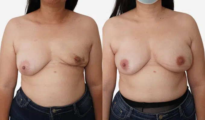 Poitrine  avant et apres mastectomie du sein gauche Dr Benjamin Sarfati paris