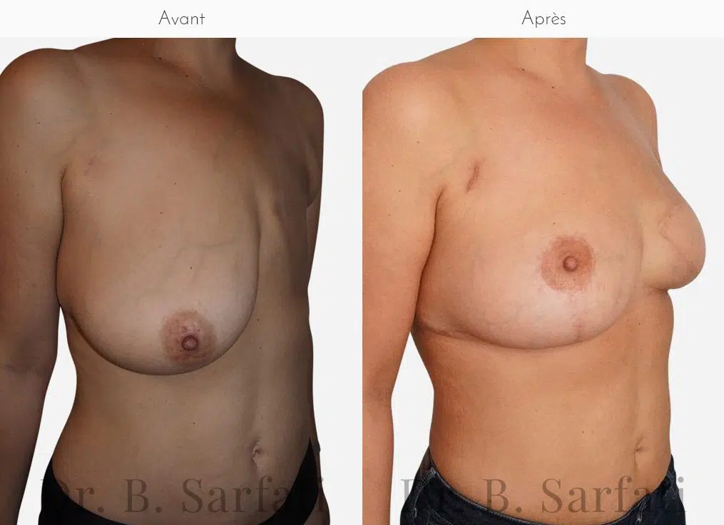 Poitrine de femme avant et apres une reconstruction mammaire par injection de graisse Dr Benjamin Sarfati paris