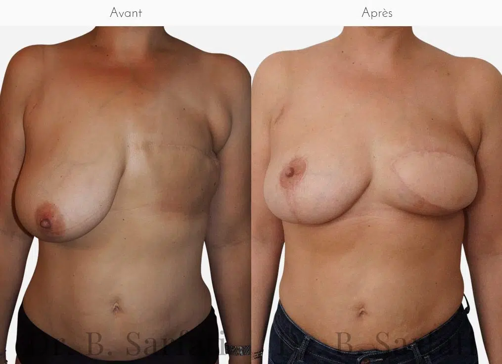 Poitrine de femme avant et apres une reconstruction mammaire par injection de graisse Dr Benjamin Sarfati paris
