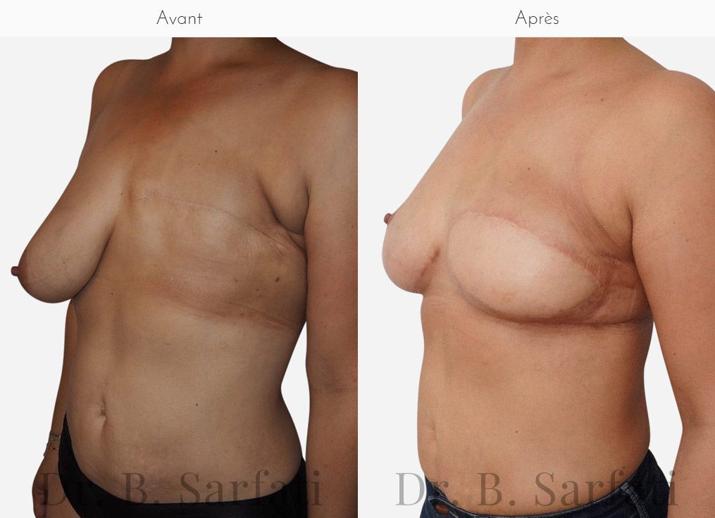 Reconstruction mammaire (grand dorsal) à Paris | Dr B. Sarfati