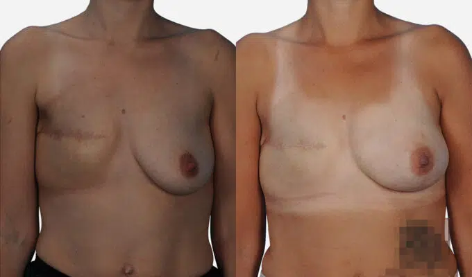 Poitrine avant et apres une reconstruction mammaire par prothese anatomique Dr Benjamin Sarfati paris