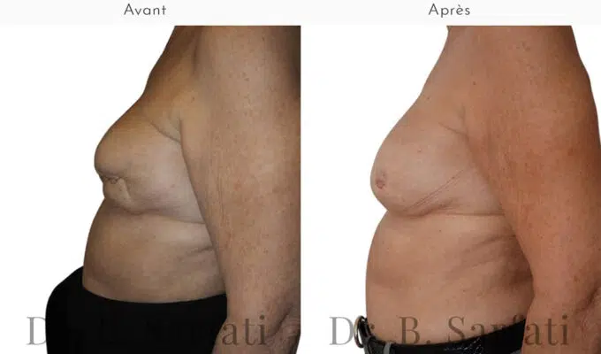 Poitrine  avant et apres une reconstruction mammaire par injection de graisse Dr Benjamin Sarfati paris