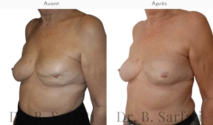 Poitrine de femme avant et apres une reconstruction mammaire par injection de graisse Dr Benjamin Sarfati paris